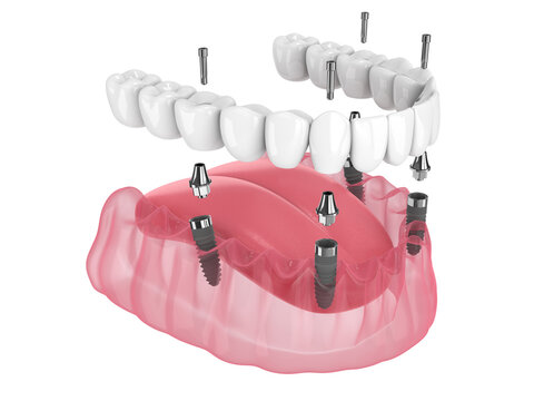 Implantes dentales all on four