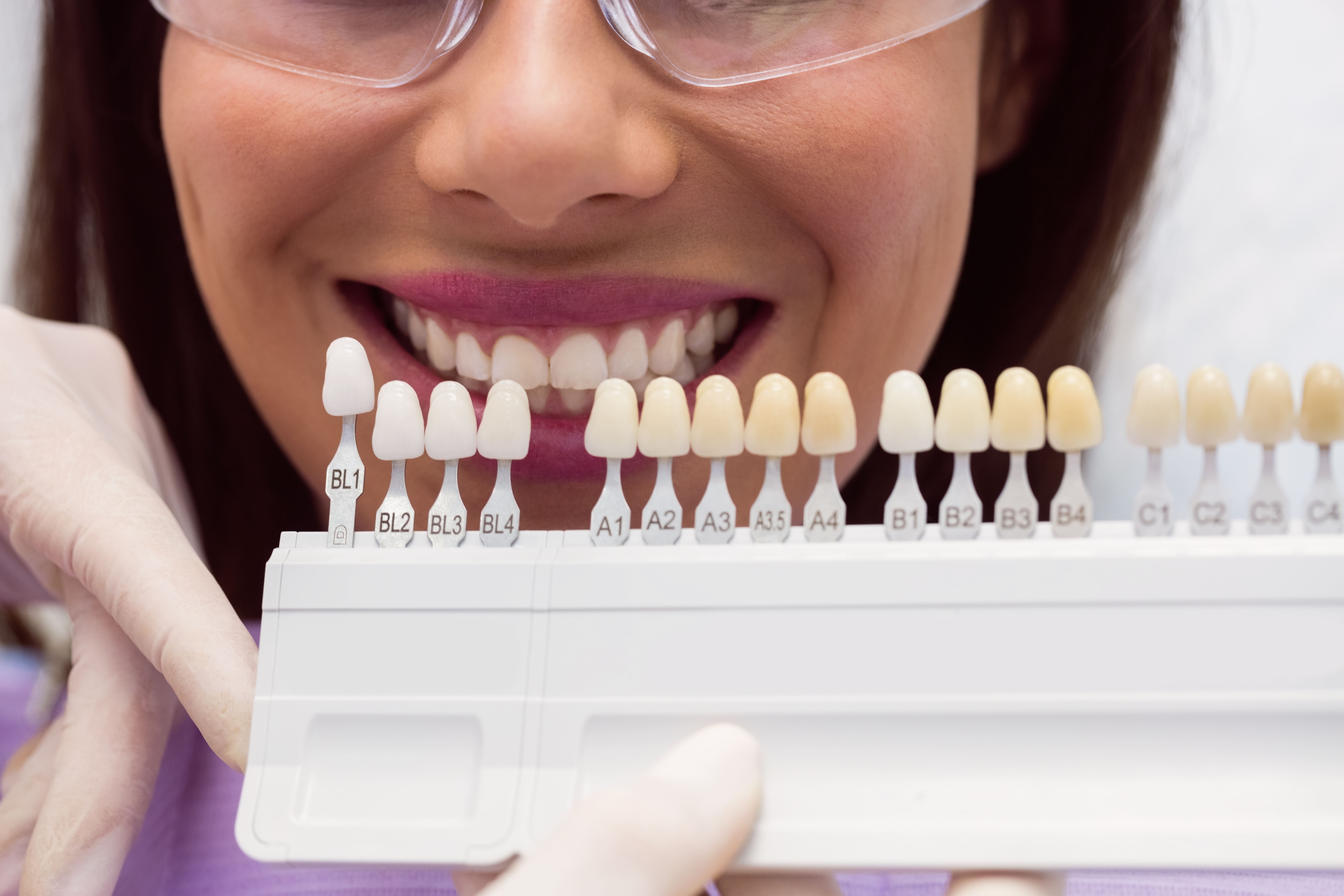 Blanqueamiento Dental en Valencia