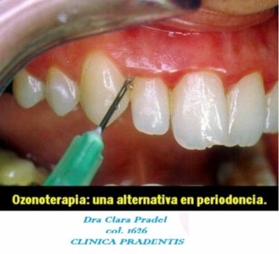 Ozonoterapia Dental en Valencia
