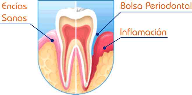 Periodoncia en Valencia